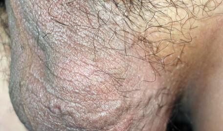 精索静脉曲张图片是什么样的呢