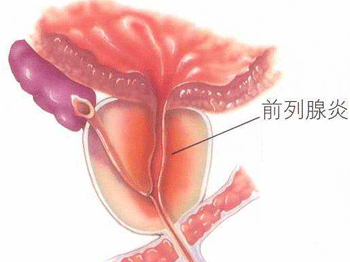 前列腺增生症的医治