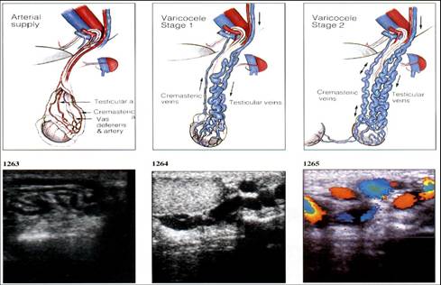 精索静脉曲张是什么样的图