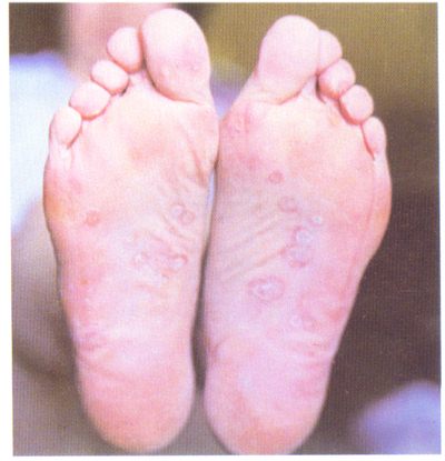 ÷��ͼƬ��÷��֢״��÷�����κ���