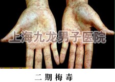 二期梅毒的症状图片