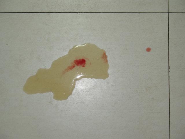 小便带血是什么原因