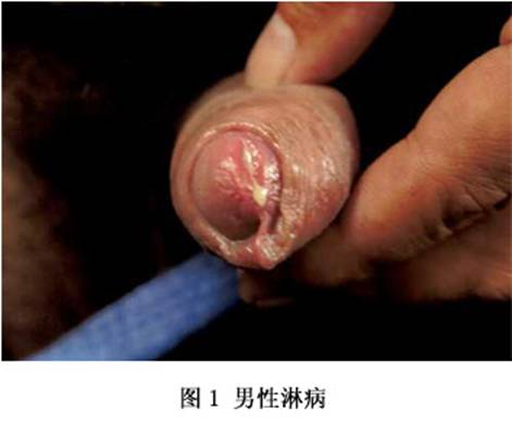 性病的早期症状图