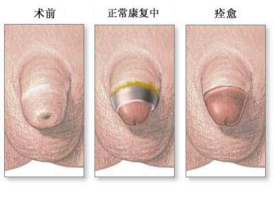 包茎手术效果图片