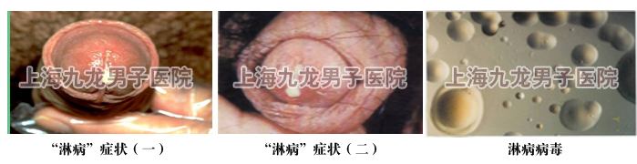 淋病临床诊断和注意事项