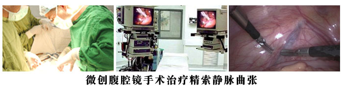 微创腹腔镜技术静脉曲张