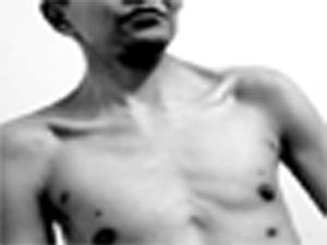 惊奇!徐州一男子竟长出7个乳头